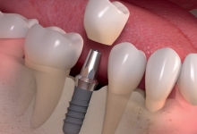 Implanturi dentare
